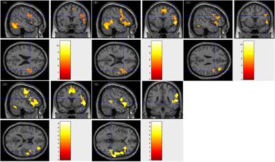 Pre-surgical Language Mapping in Epilepsy: Using fMRI in Chinese-Speaking Patients